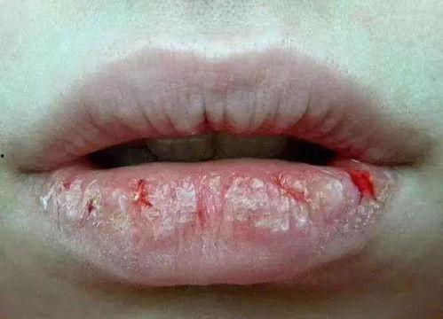 吃网纹瓜嘴唇疼
